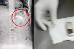 जेल में बंद कैदी का X-Ray देख मचा हड़कंप, पेट में दिखा मोबाइल, डाक्टरों ने ऐसे बचाई जान